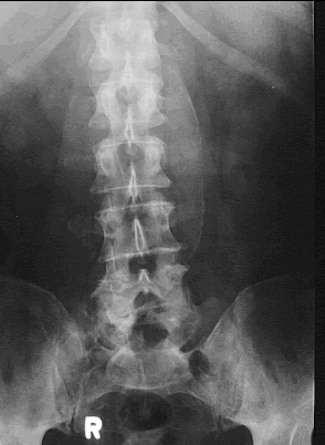 blog Rx,Tc e Rm....: ANEURISMA DA AORTA ABDOMINAL