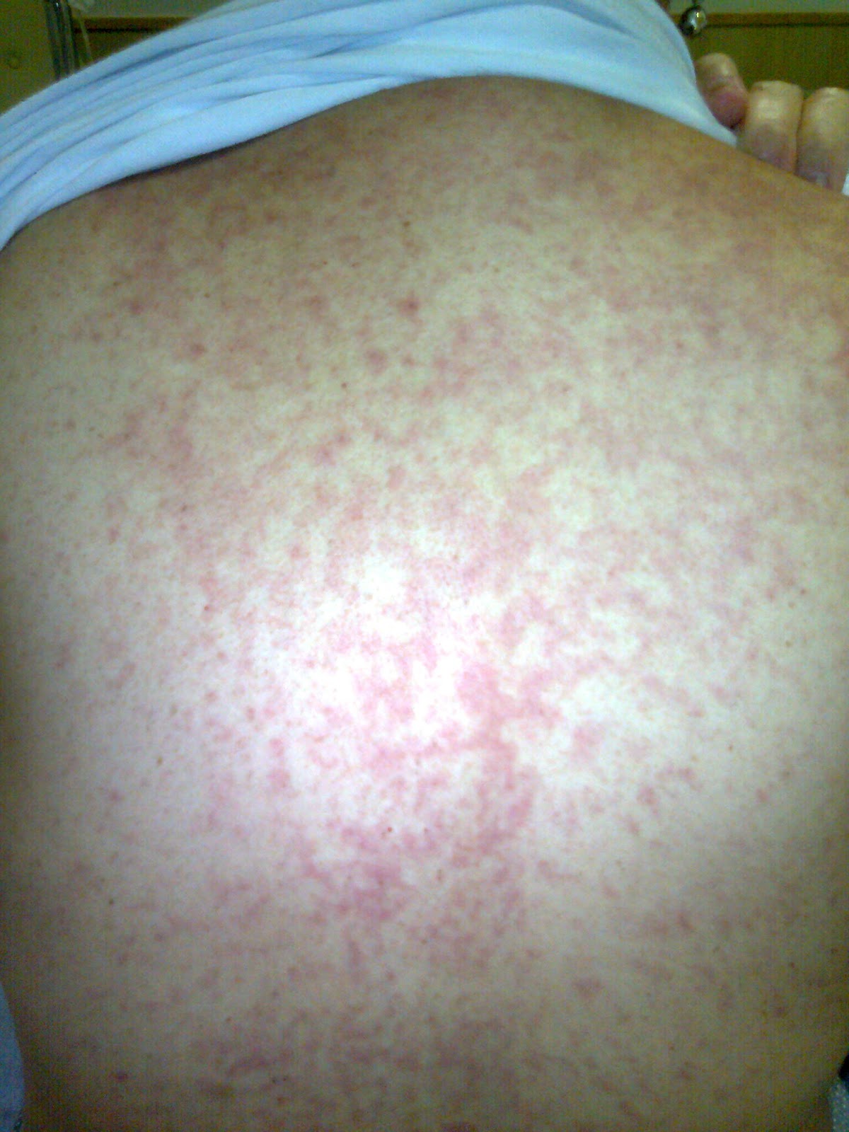 Removendo Montanhas - minha luta contra LLA (Leucemia Linfóide Aguda