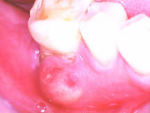 acute dental abscess