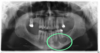 Dental Malpractice
