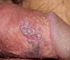 Penyakit Herpes Pada Penis Penyakit Herpes Pada Penis