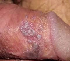 Penyakit Herpes Pada Penis