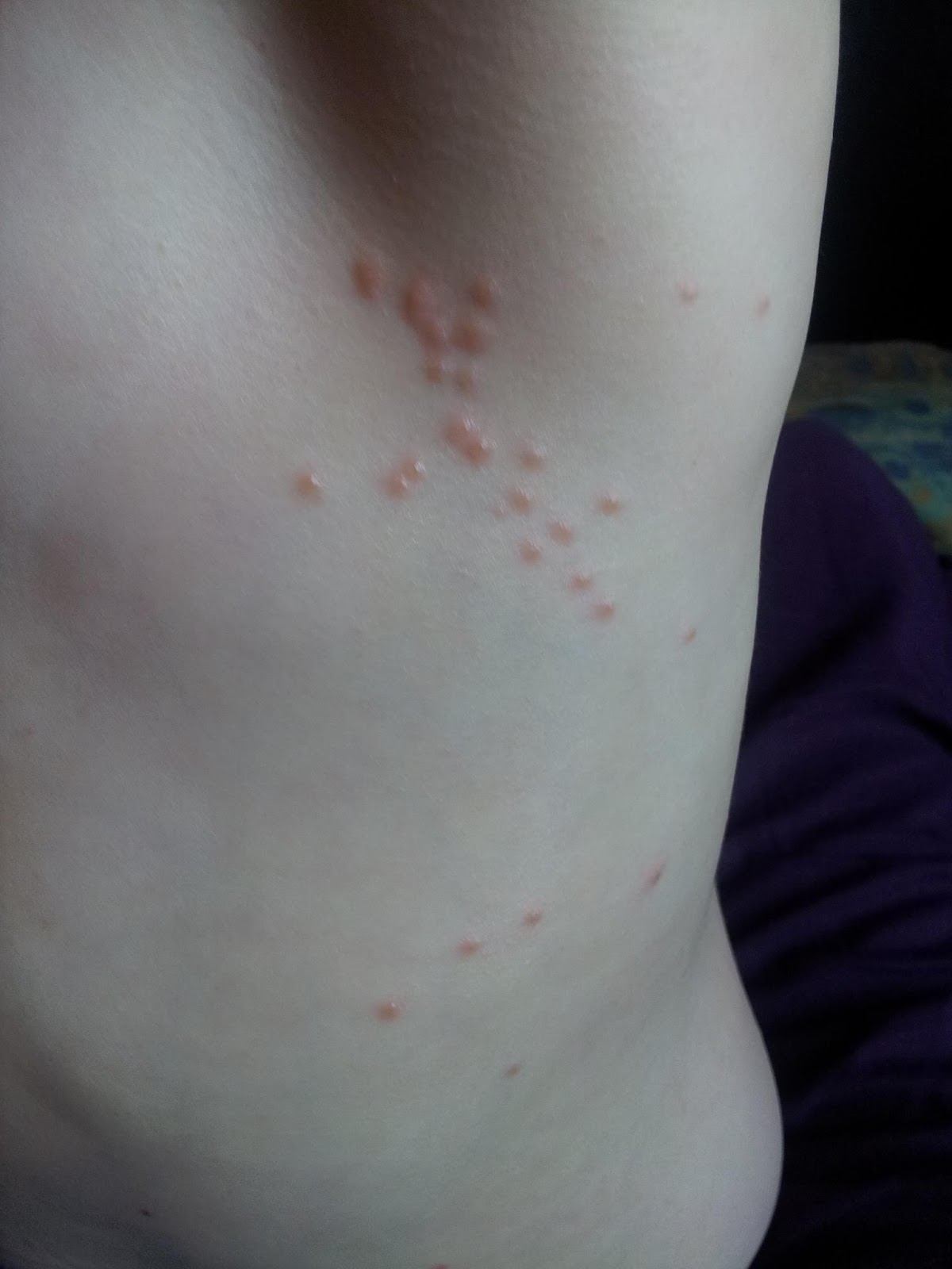 Life...in Leighland 4 year old with Shingles!