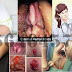Jenis Obat Buat Wasir (Hemoroid) Yang Parah thumbnail