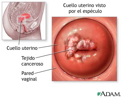 LAS LESIONES INTRAEPITELIALES CERVICALES las lesiones intraepiteliales cervicales: