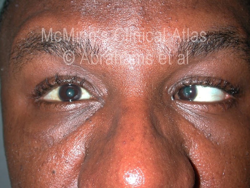 Medix: Abducent nerve palsy / Sixth nerve palsy