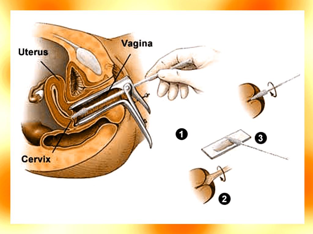 Cervical Cancer