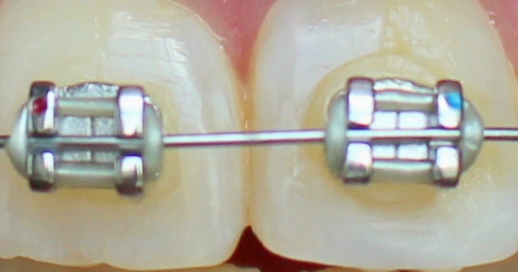 My Chaotic World Staining of the Glue on My Teeth