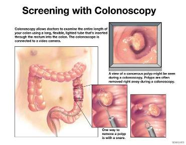 What happens during a colonoscopy?