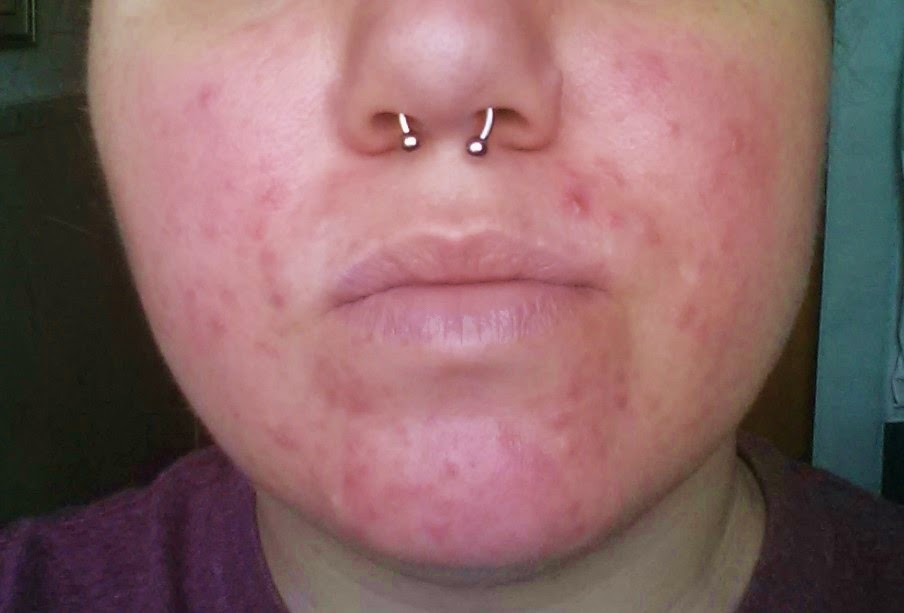 Face Is So Dry It Burns Face Is So Dry It Burns