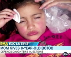 botox baby