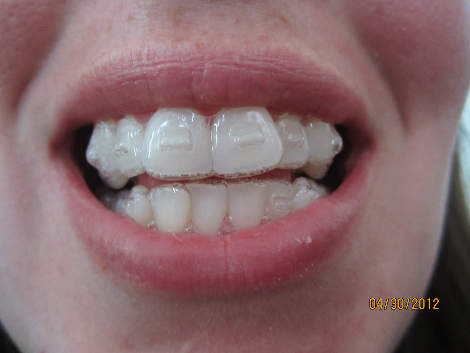 My Invisalign Journey!