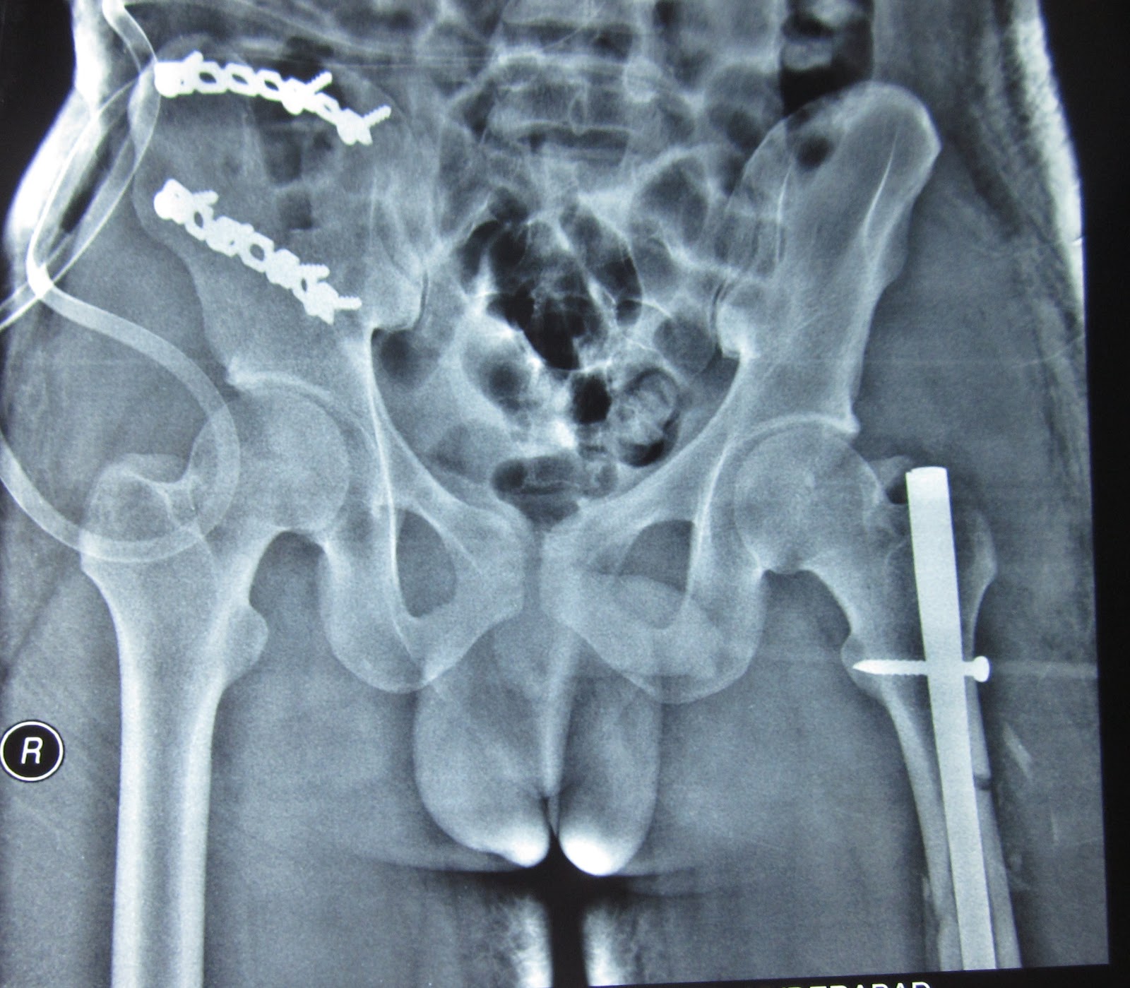 CRUSH INJURY OPEN PELVIC FRACTURE, ASSOCIATED FEMUR FRACTURE ON