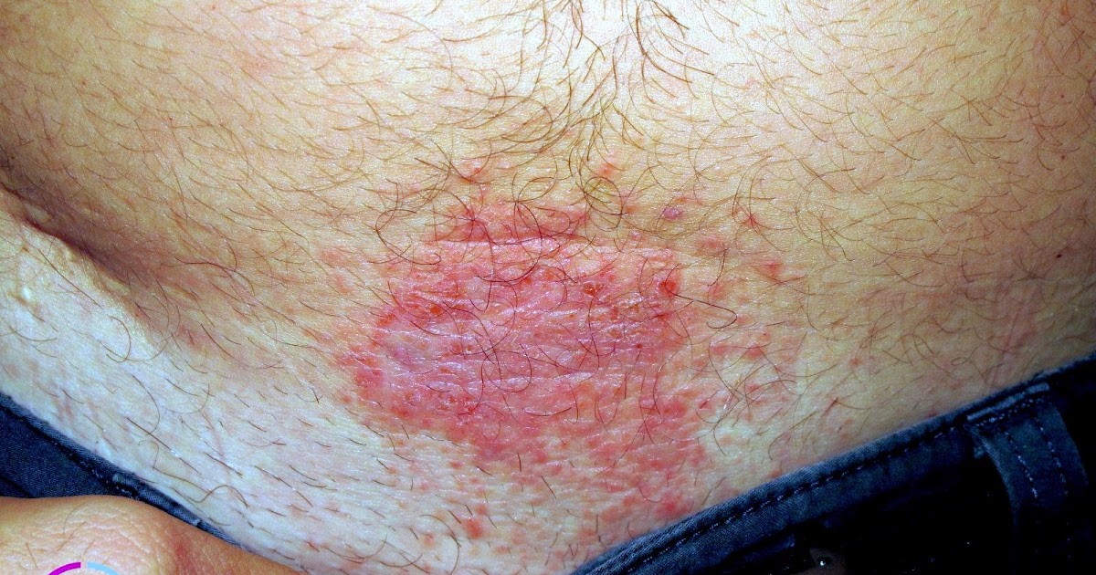 La psoriasis el tratamiento el ungüento sulfúrico