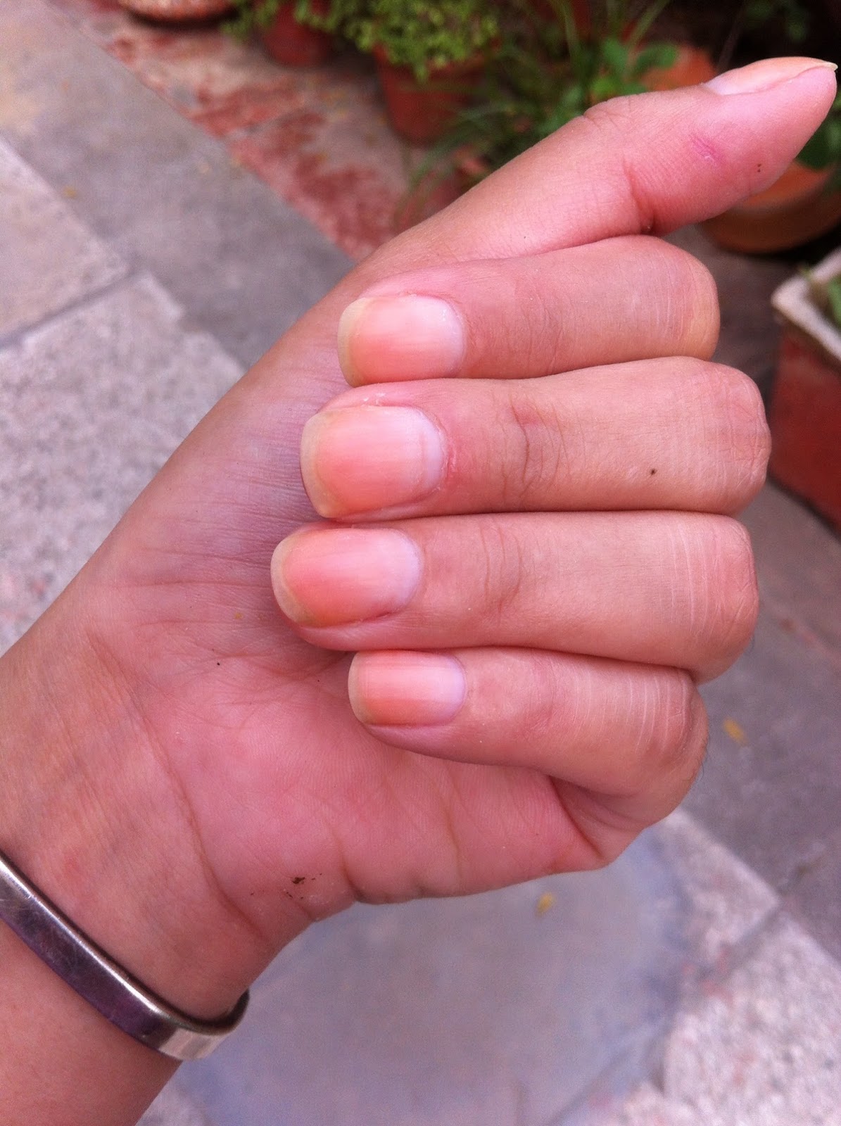 Home Remedies for Yellow Nails