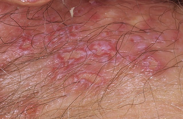 Complete Facts of Female Genital Herpes