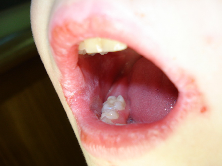 Dermatology For Dentists and Dental Students Lips