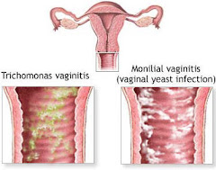 Waa maxay cudurka dumarka ku dhaca ee vaginitis