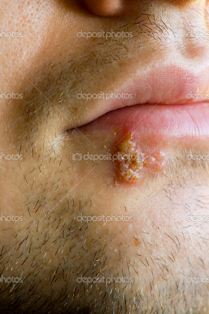 Oral Herpes On Genitals : Equine Viral Arteritis (eva)