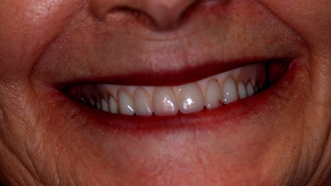 Bad Fitting Dentures Fit Choices