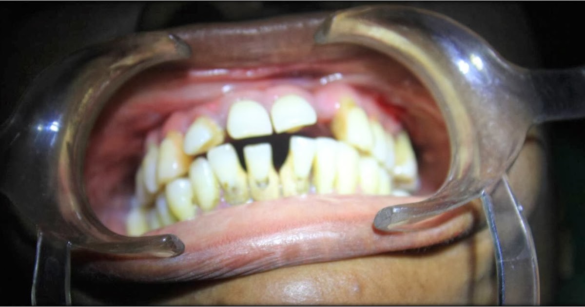 Dental implants for patients with diabetes, with predicatable success