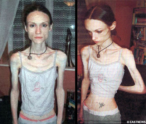 http://2.bp.blogspot.com/-yr4YVLJjAxQ/USF6GWiqHZI/AAAAAAAABzw/FMVB-_fQbBk/s1600/Anorexia+nervosa.jpg
