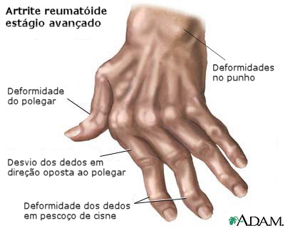 patologias - artrite reumatóide a artrite reumatóide se encontra na classe de patologias que ocasionam deformidades