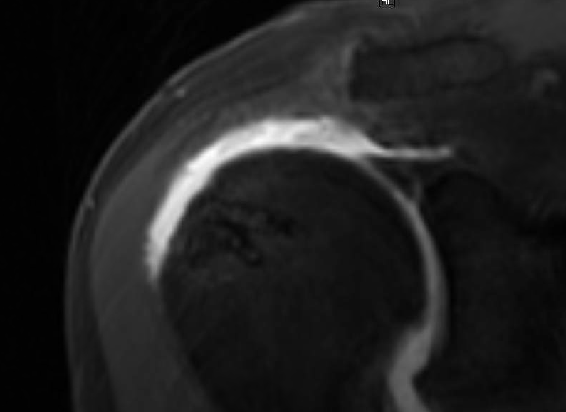 Shoulder Arthritis / Rotator Cuff Tears causes of shoulder pain Failed rotator cuff surgery in
