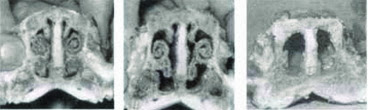 Hình 1: Xoang mũi bị hư trong bệnh viêm teo mũi truyền nhiễm do Bordetella bronchiseptica và Pasteurelle multocida type D