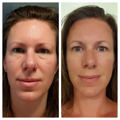 You Naturally Beautiful: L'BRI Skin Care Before and After Picture