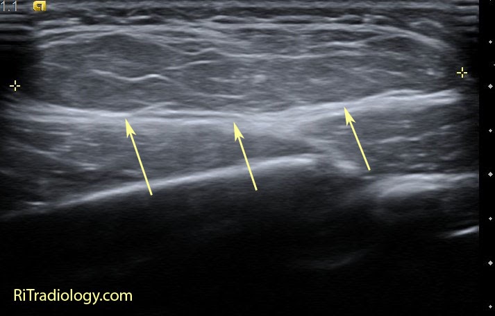 RiT radiology: Soft Tissue Lipoma