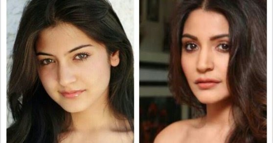 Anushka Sharma Plastic Surgery Disaster- Anushka before and after