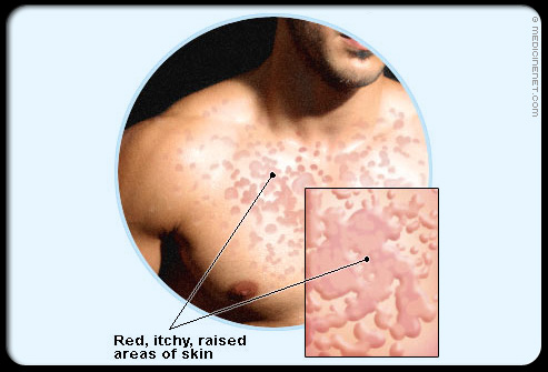 Treatment with antiviral drugs