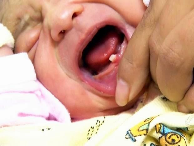 Em caso raro, bebê nasce com dente formado em cidade de Mato Grosso
