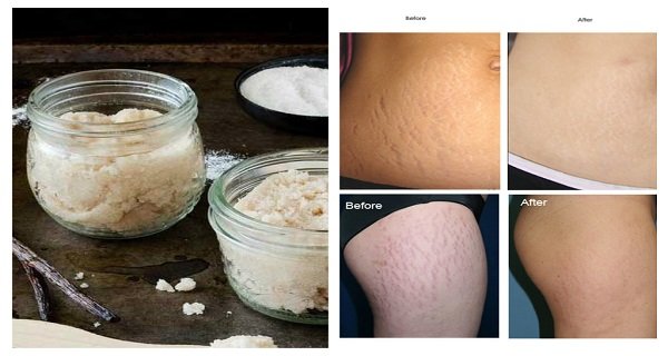 Say goodbye to stretchmarks forever! 100% effective homemade recipe! Say goodbye to stretchmarks forever! 100% effective homemade recipe!