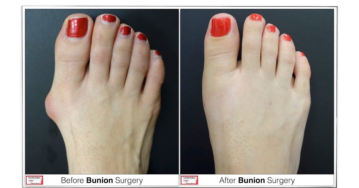 Swiss Compression Technique for Correcting Bunions PostOperative Care