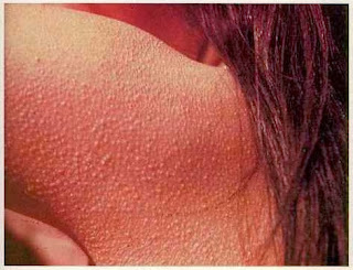 Chicken Skin Natural Remedies For Keratosis Pilaris - Getting Rid of Chicken Skin