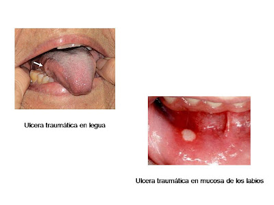 Ulceras de la boca traumaticas