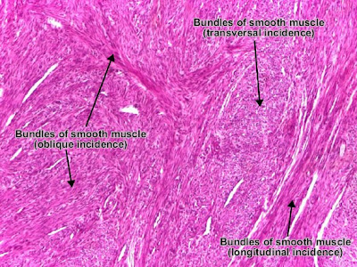 Histology and Explanation of leiomyoma Uterus