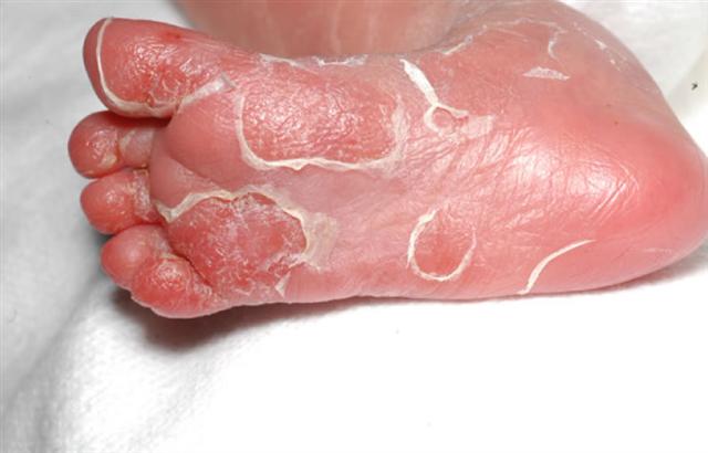 Early Stage Syphilis