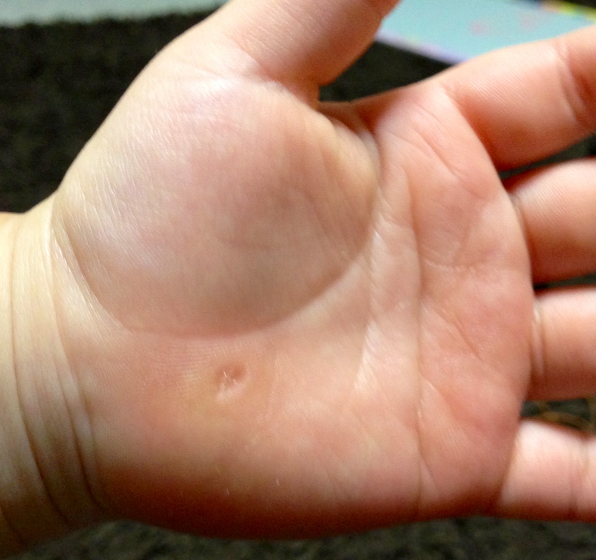 アロマな生活 必見 イボがとれたの 写真あり