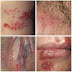 Herpes Simplex Obat thumbnail
