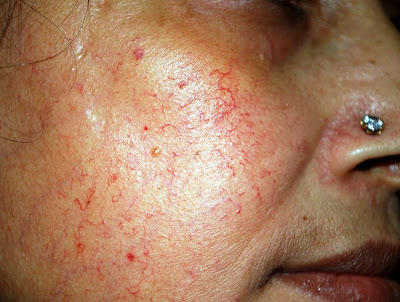 Steroid creams for face rash