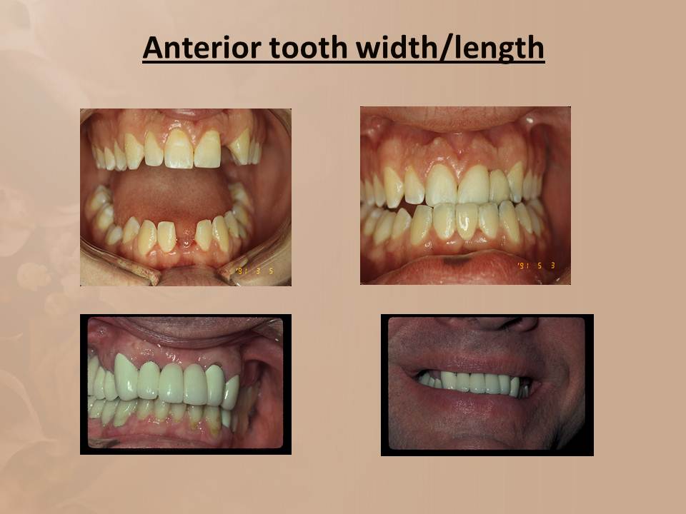 DOs and DONTs in DENTISTRY 4 Critical Aspects Of Anterior Dental Morphology we neglect