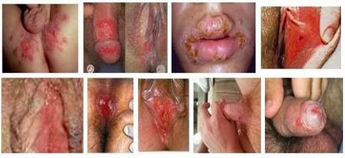 Penyakit Kutil Kelamin Penyakit Kutil Kelamin