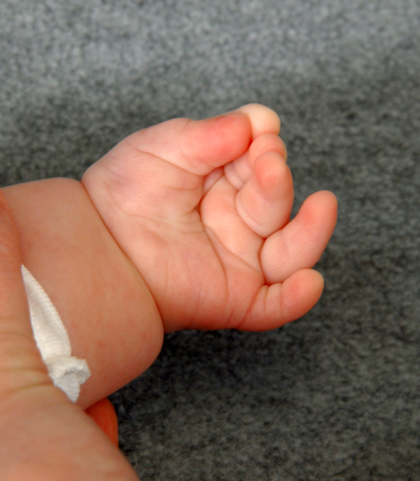 Small finger polydactyly, extra fingers Congenital Hand and Arm