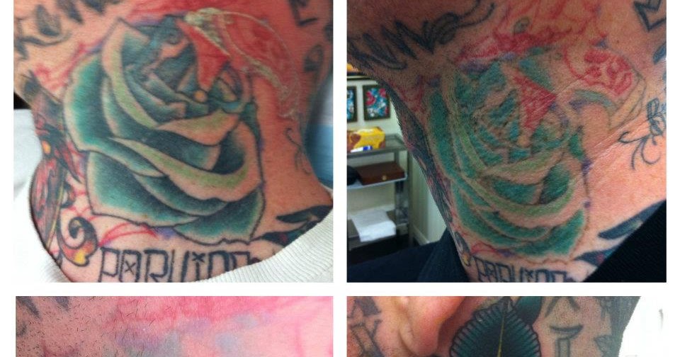third eye tattoo laser removal with mike driver third eye tattoo laser removal with mike driver