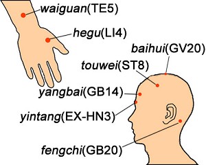 AKUPUNKTUR SAKIT KEPALA