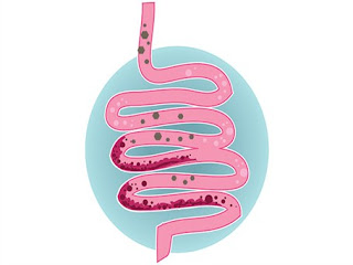 komplikasi radang usus komplikasi radang usus