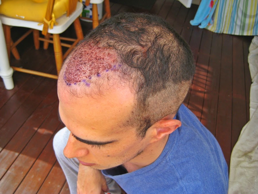 Hair Transplant Surgery and Its Centre's in India Hair Transplant Surgery and Its Centre's in India
